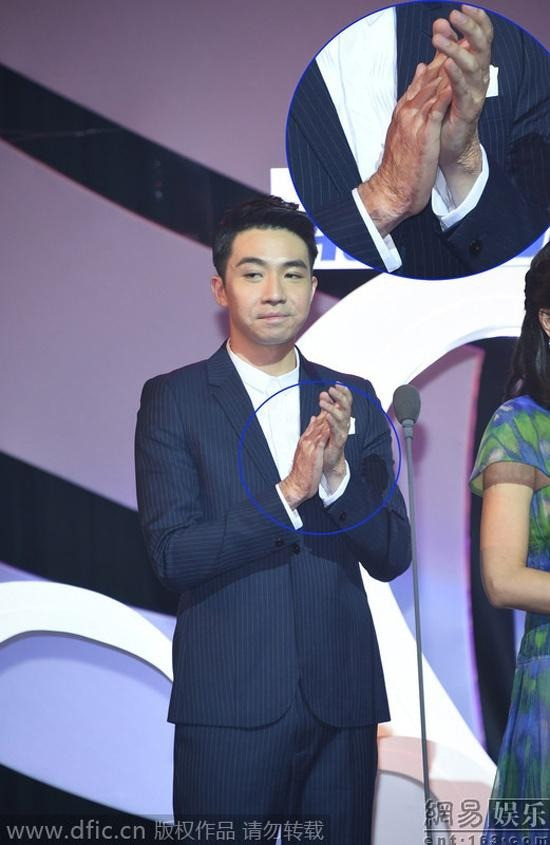 Nam thần F4 từng bị bỏng nặng 39 hủy hoại dung nhan giờ ra sao