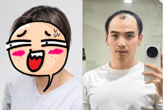 Ông xã H'Hen Niê gây choáng với giao diện sau khi cấy tóc?