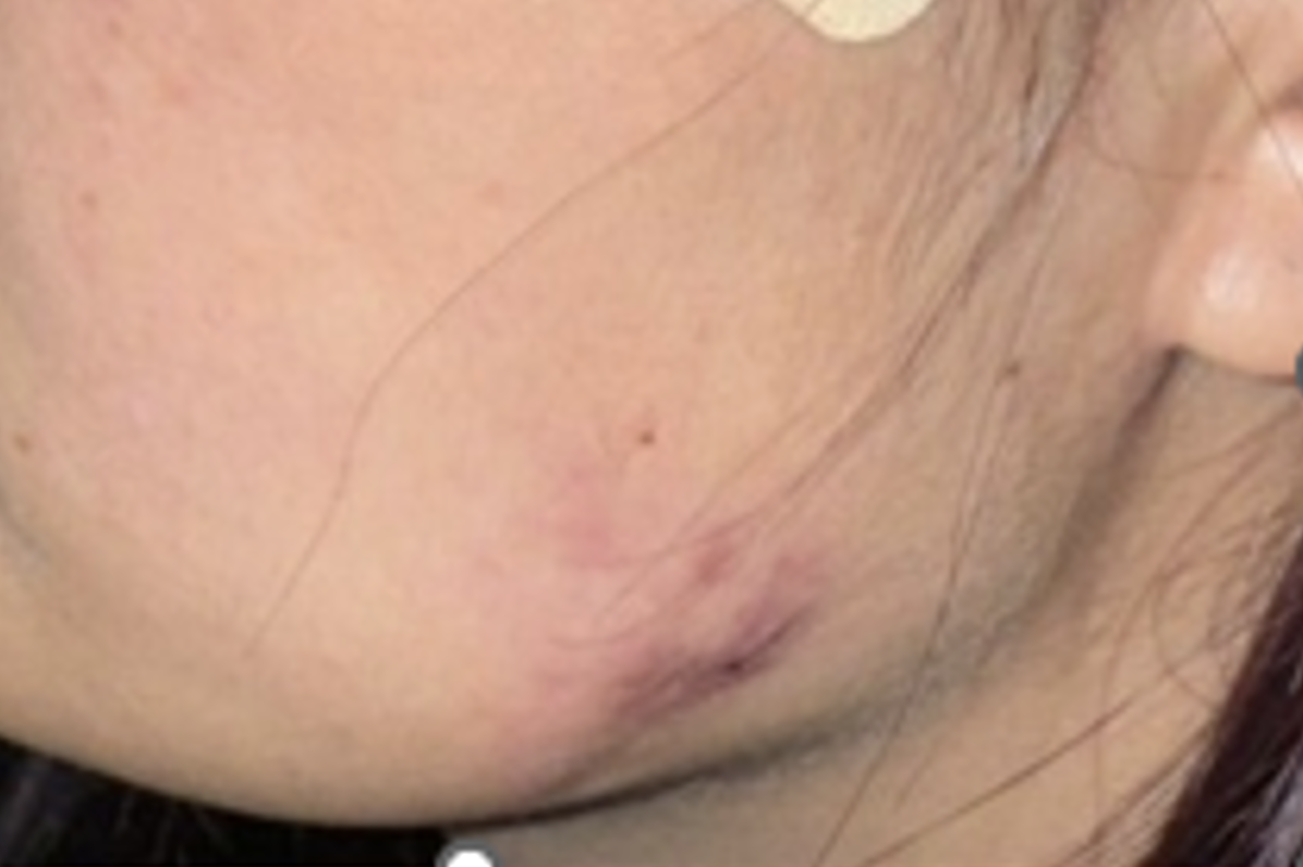 tiem botox bien chung