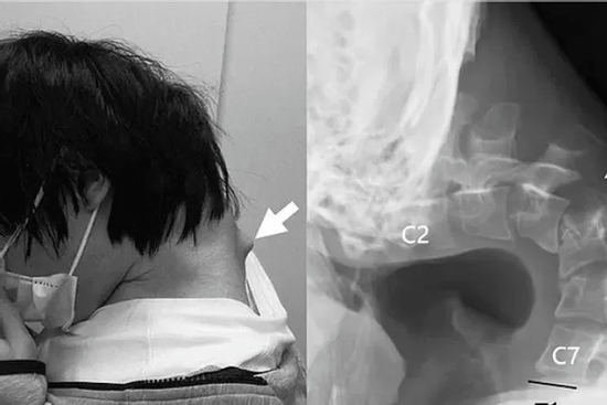 Nhìn điện thoại quá nhiều, nam thanh niên không thể ngẩng đầu