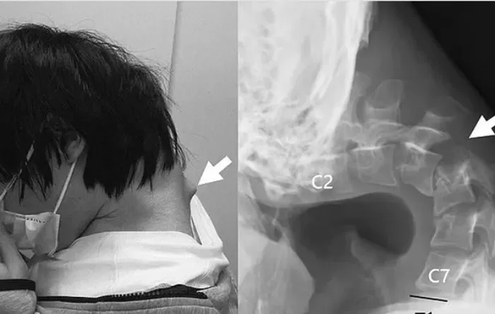 Chàng trai bị u sau gáy do cúi đầu chơi điện thoại quá nhiều.