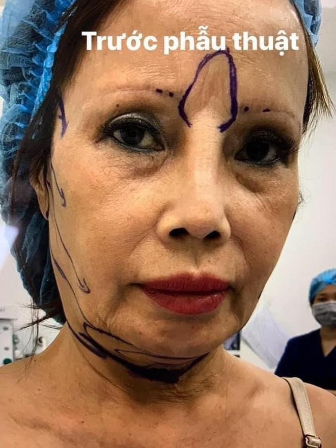 Sốc diện mạo cô dâu Cao Bằng Thu Sao sau thẩm mỹ