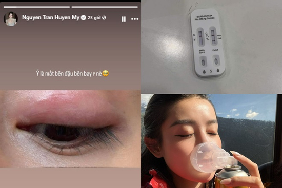 Á hậu Huyền My gây hoang mang khi lộ mắt sưng vù, sức khỏe liên tục báo động