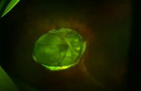 Lạ lùng người phụ nữ 'mọc hoa' trong mắt suýt bị mù, bác sĩ phát hiện điều đáng sợ