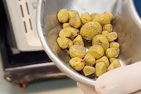 Người đàn ông phải mổ lấy 35 viên sỏi do uống một loại nước phổ biến hằng ngày