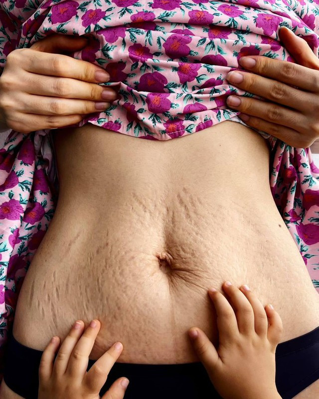 4 năm sinh bé Bo Hòa Minzy vẫn bị soi vết rạn bụng nhăn nheo lộ rõ