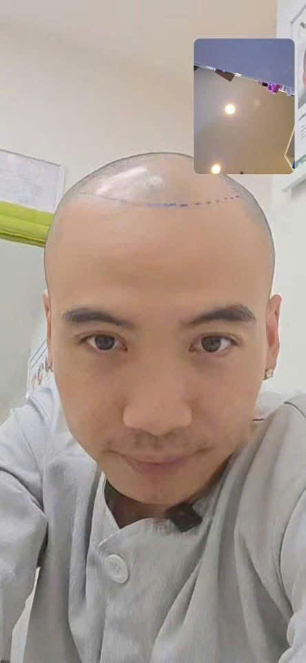 Lộ ảnh chồng HHen Niê đi cấy tóc ở bệnh viện sau màn công khai đầu hói gây sốc