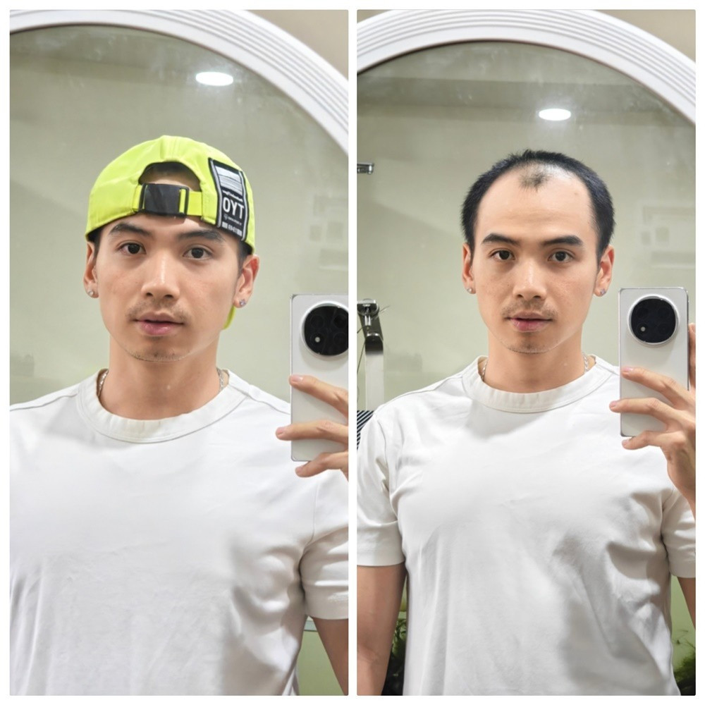 Lộ ảnh chồng HHen Niê đi cấy tóc ở bệnh viện sau màn công khai đầu hói gây sốc