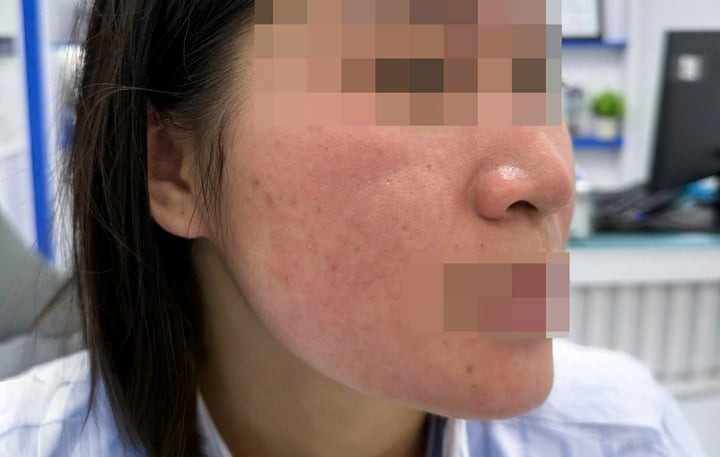 Bỏng da mặt vì dùng chanh tươi trị mụn Các vùng da bong tróc, sưng tấy sau chữa mụn bằng nước chanh. (Ảnh: BSCC)