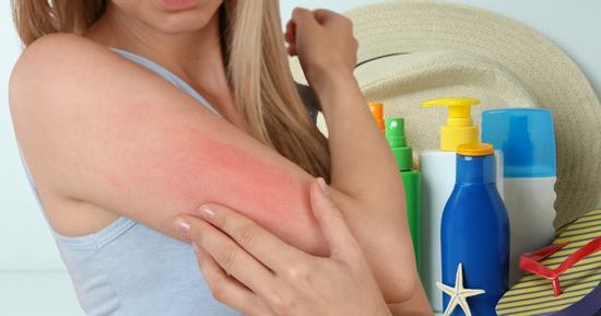Cách xử trí khi bị dị ứng kem chống nắng