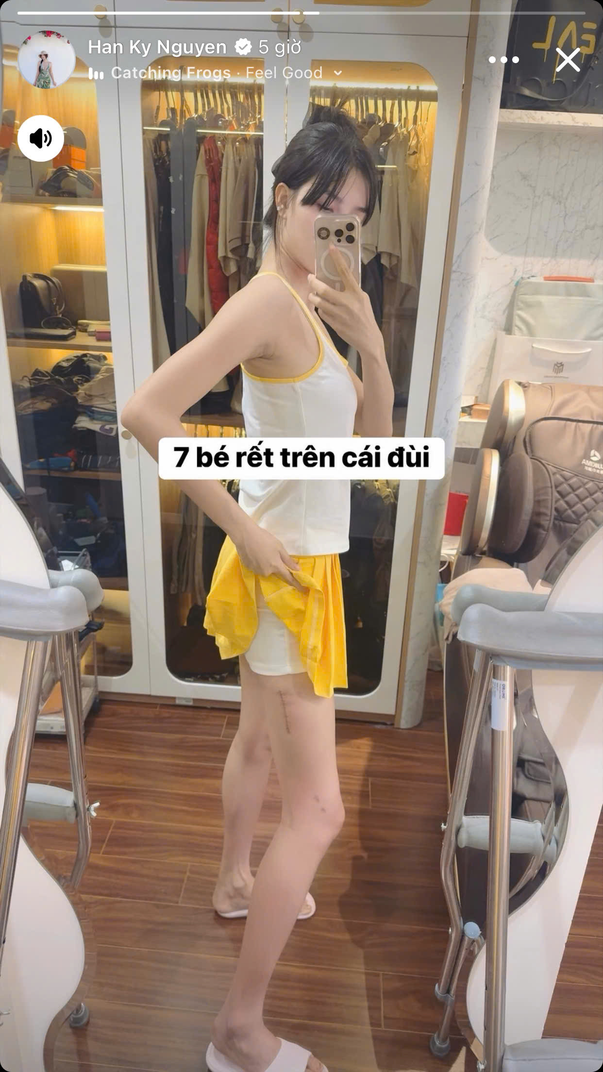 Kỳ Hân lộ đôi chân đầy 'con rết' sau chấn thương gãy đùi trên sân pickleball Kỳ Hân lộ đôi chân đầy con rết sau chấn thương gãy đùi trên sân pickleball