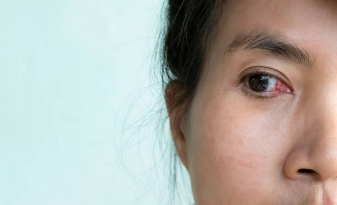 5 biến chứng nguy hiểm nếu bạn đeo kính áp tròng quá lâu- Ảnh 1.
