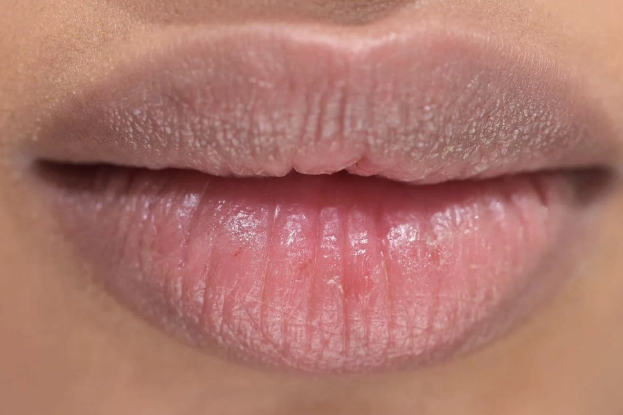 Nguyên nhân khiến môi thâm và cách khắc phục hiệu quả- Ảnh 1.