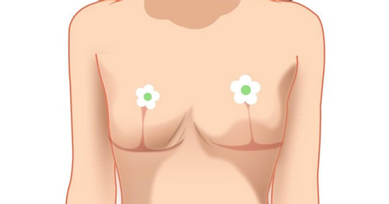 Biến chứng thẩm mỹ ngực sa trễ