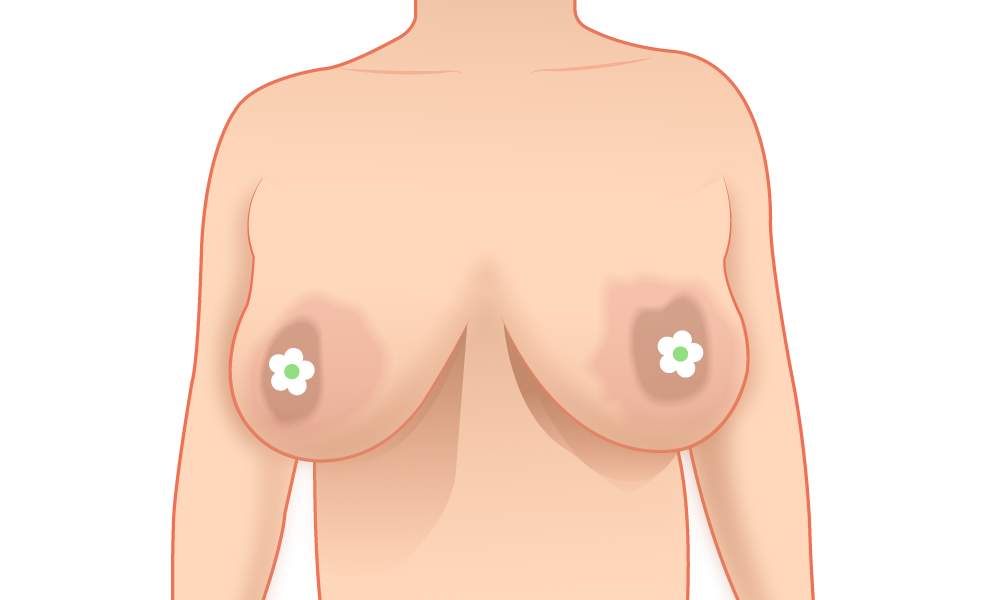 Biến chứng thẩm mỹ ngực sa trễ- Ảnh 1.