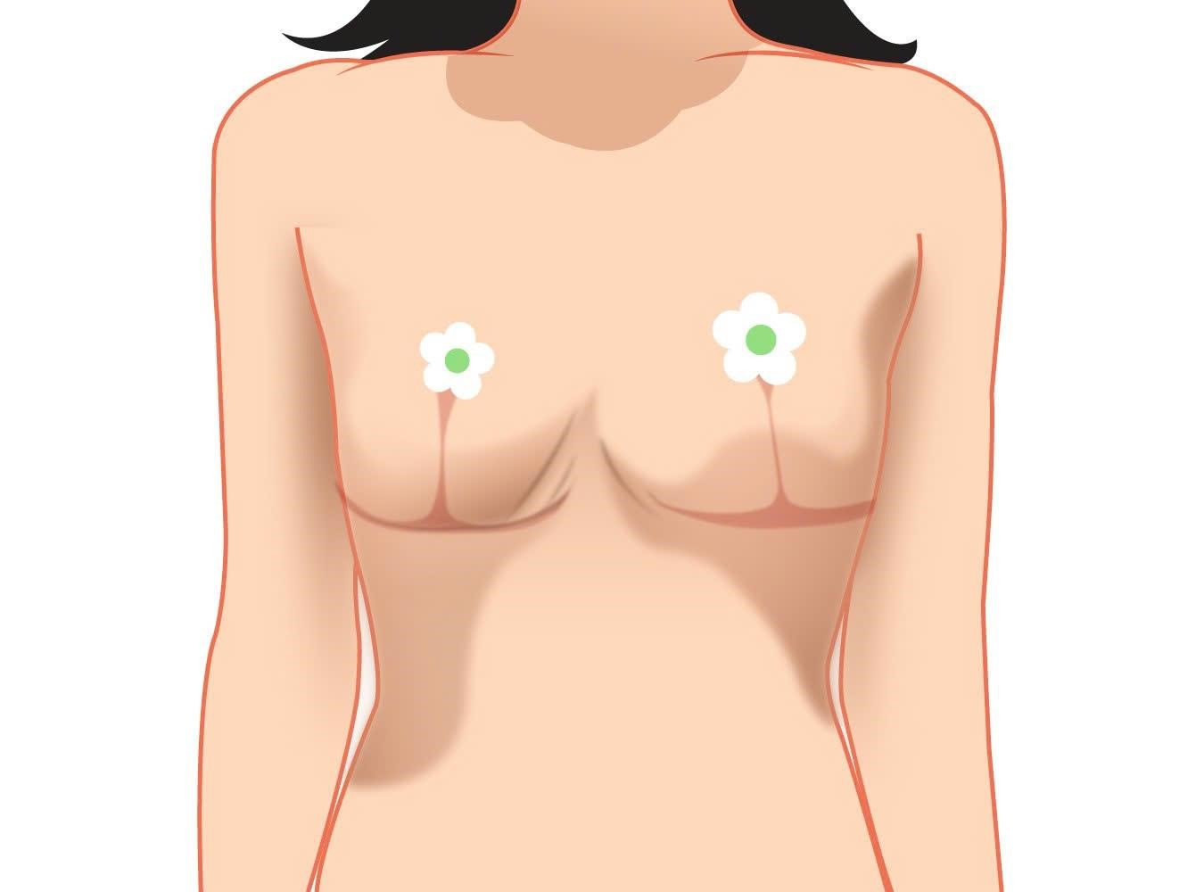 Biến chứng thẩm mỹ ngực sa trễ- Ảnh 3.