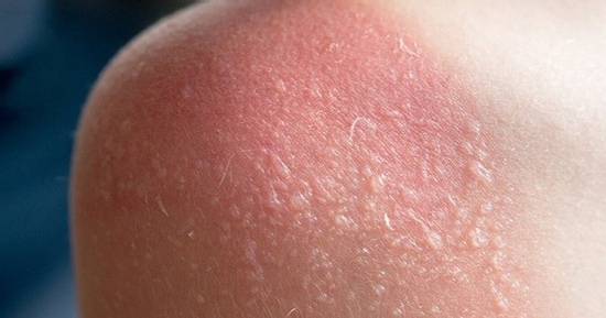 Cách khắc phục làn da bị cháy nắng