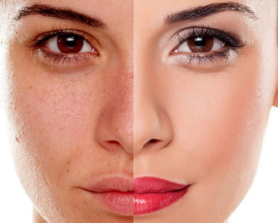 Cách khắc phục làn da bị cháy nắng- Ảnh 3.