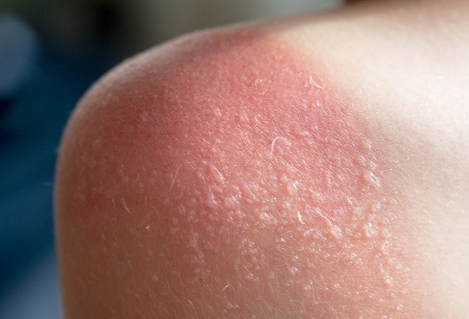 Cách khắc phục làn da bị cháy nắng- Ảnh 1.