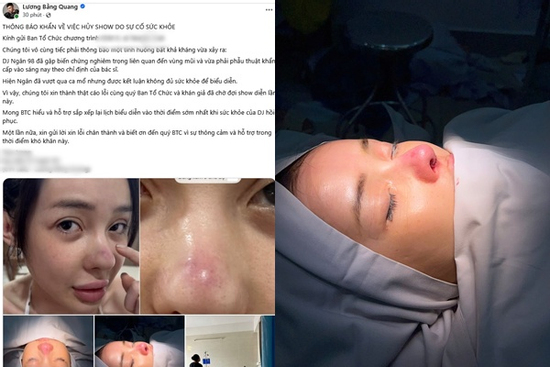 Ngân 98 công khai hình ảnh biến chứng thẩm mỹ mũi nặng khiến ai cũng sốc!