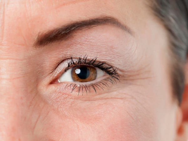 Vết chân chim xuất hiện là do đâu? Làm thế nào để khắc phục? - Ảnh 1