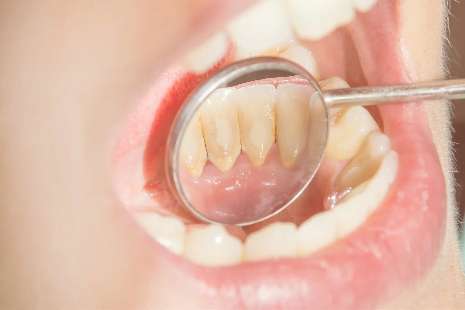 Cách nhận biết cao răng đang tích tụ- Ảnh 1.