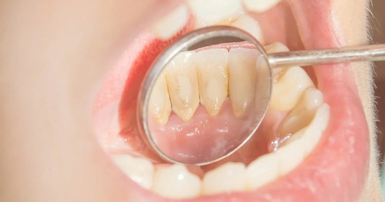 Cách nhận biết cao răng đang tích tụ