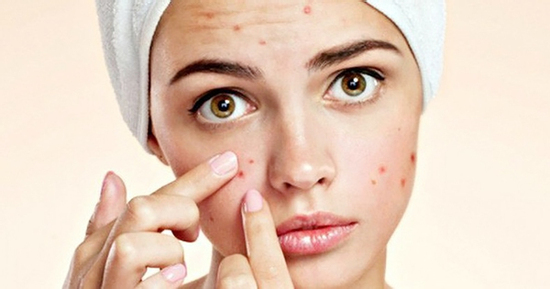 Nguy cơ tử vong từ thói quen tự nặn mụn