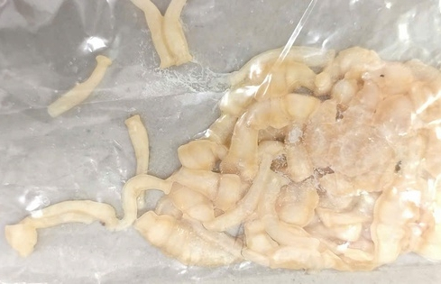 Phát hiện sán dây dài 3 mét sống trong ruột sau gần 1 năm đau bụng âm ỉ