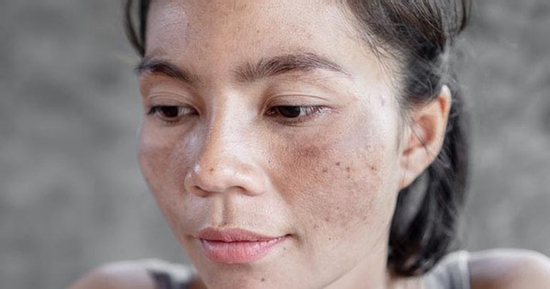 7 vấn đề về da mùa hè có thể ngăn ngừa