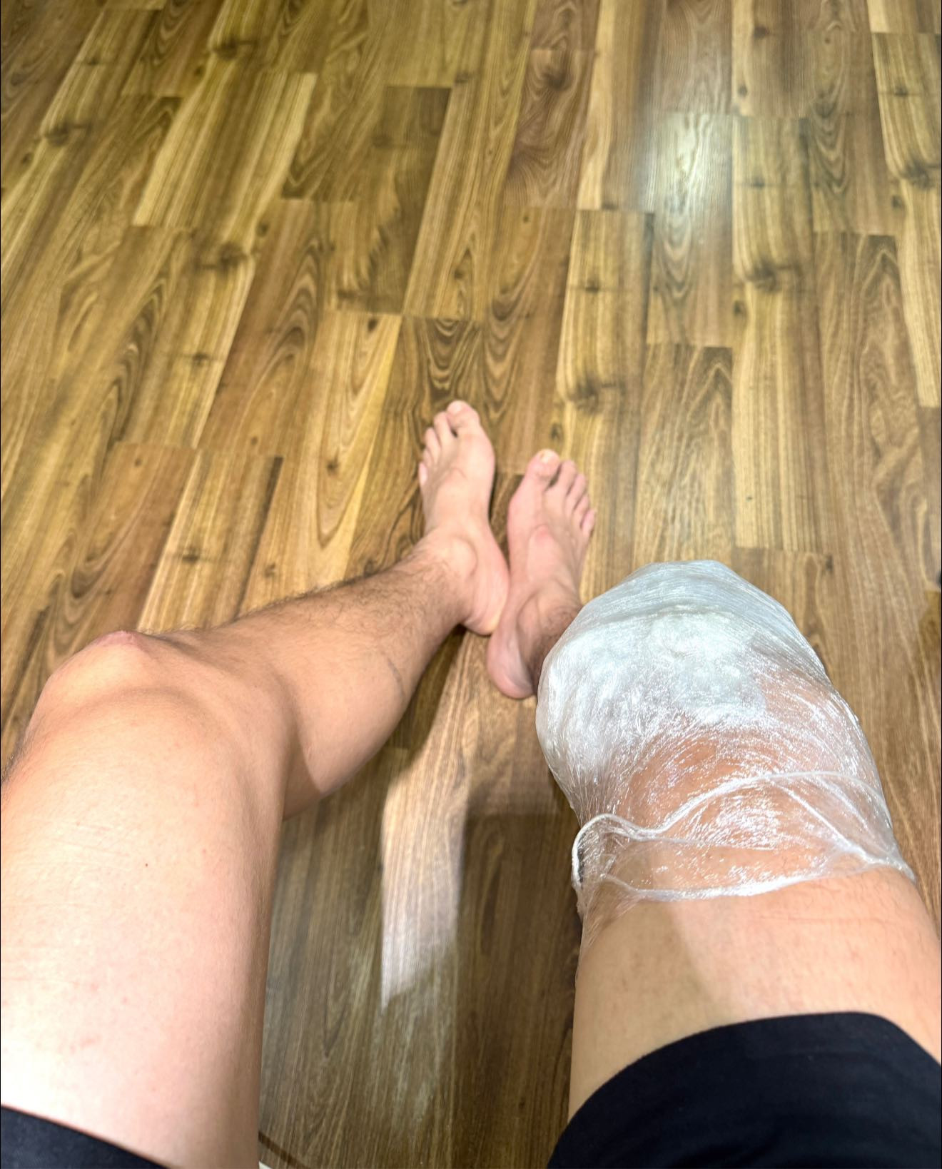 Diễn viên Bình An lên bàn mổ sau 1 năm chấn thương nghiêm trọng