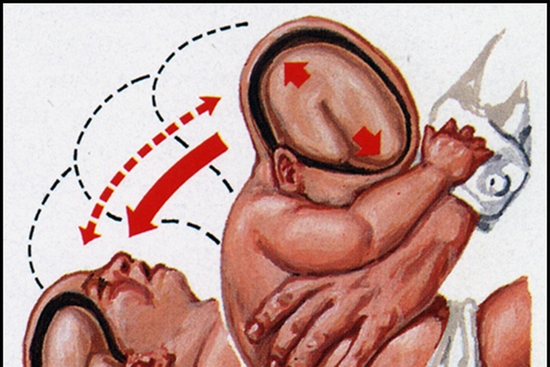 Bố lắc con để ru ngủ khiến em bé 4 tháng tuổi bị bại não