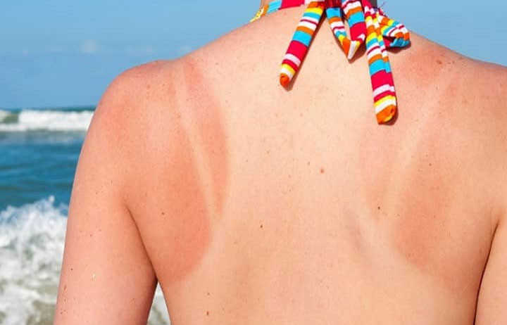 Cách phục hồi làn da sau rám nắng mùa hè - Ảnh 1.