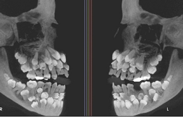 Đi nhổ răng sữa, bé gái khiến nha sĩ sốc nặng khi có 81 chiếc răng