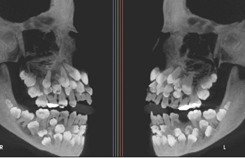 Đi nhổ răng sữa, bé gái khiến nha sĩ sốc nặng khi có 81 chiếc răng