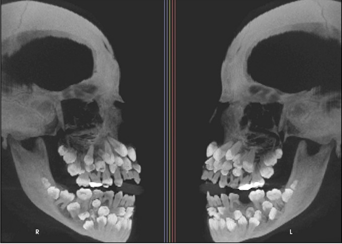 Đi nhổ răng sữa, bé gái khiến nha sĩ sốc nặng khi có 81 chiếc răng- Ảnh 1.