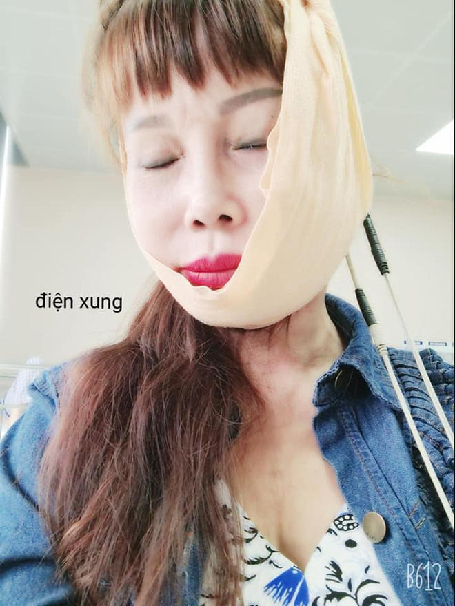 Cô dâu Cao Bằng lại thẩm mỹ ở tuổi U70 diện mạo sau dao kéo mới sốc