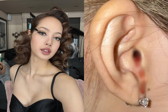Lisa (BLACKPICK) hiện ra sao sau khoảnh khắc chảy máu tai gây sốc MXH?