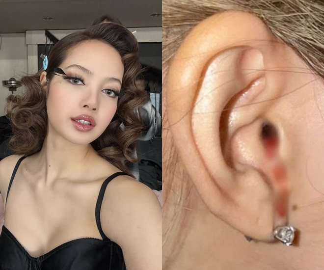 Tình trạng Lisa BLACKPICK sau khoảnh khắc chảy máu tai gây hoang mang MXH