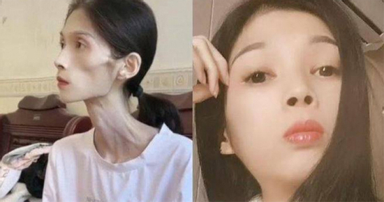 Số phận bi thảm của cô gái xinh đẹp biến thành 'bộ xương di động' 17kg