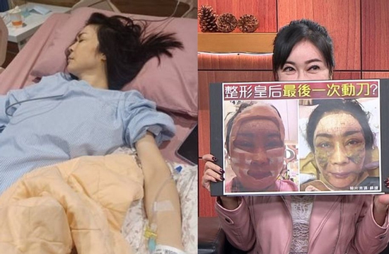 'Nữ hoàng dao kéo' chuyển từ giường bệnh ung thư sang giường phẫu thuật thẩm mỹ, gây mê 6 tiếng để căng da