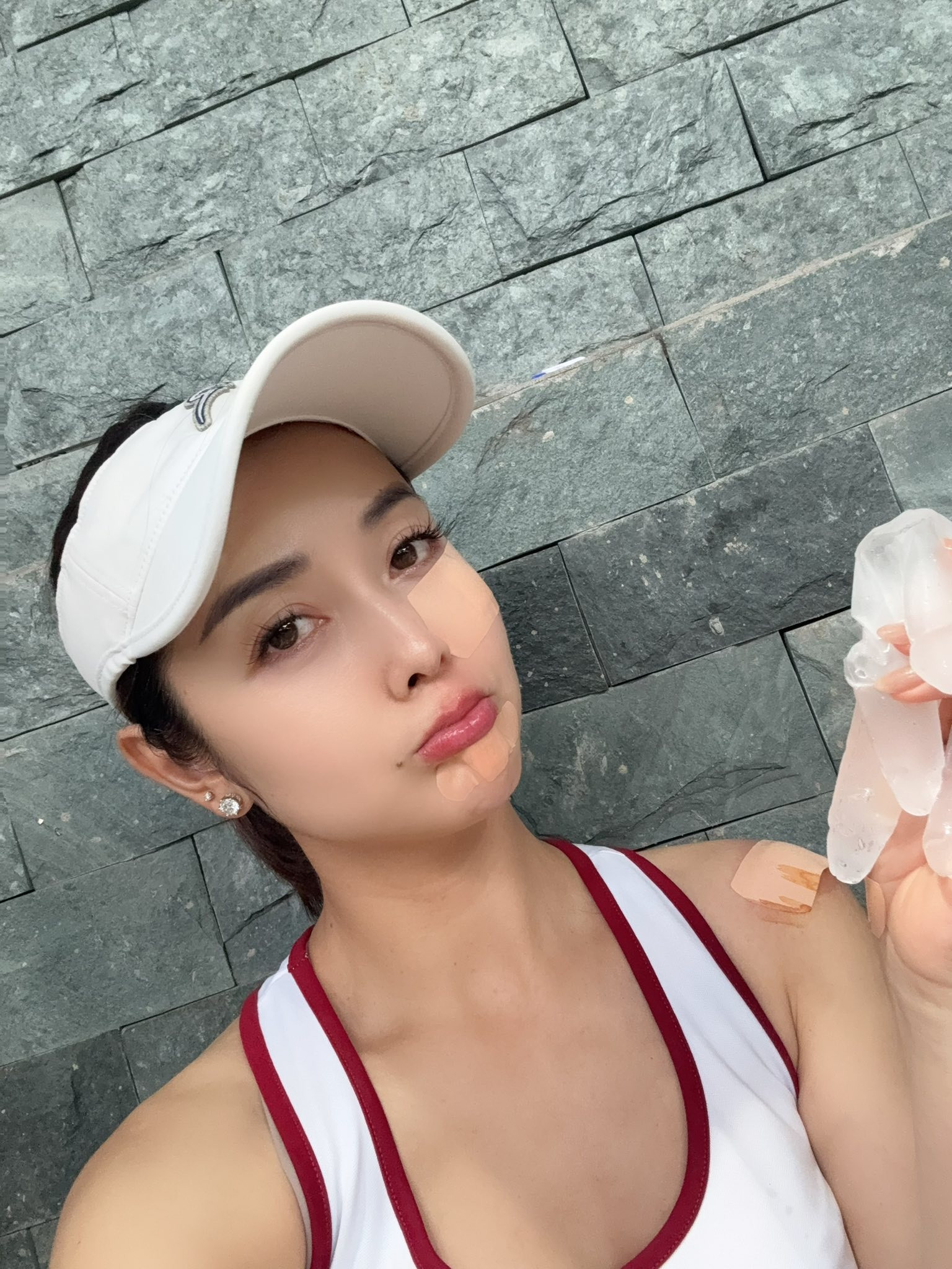 1 Hoa hậu đình đám Vbiz gặp tai nạn vì pickleball gương mặt chi chít băng gạc