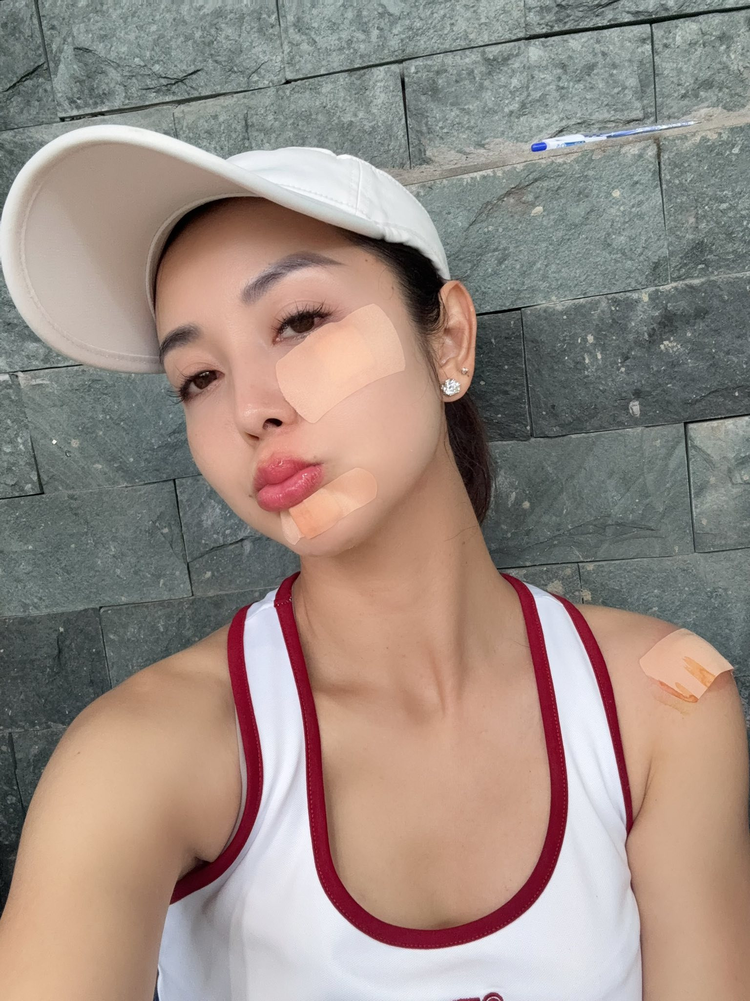 1 Hoa hậu đình đám Vbiz gặp tai nạn vì pickleball gương mặt chi chít băng gạc