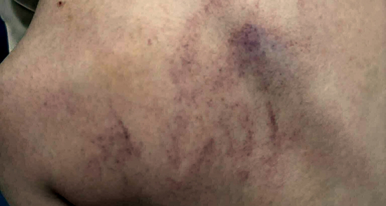 Điều tra vụ bé gái 4 tuổi nghi bị cô giáo bạo hành ở Hà Nội