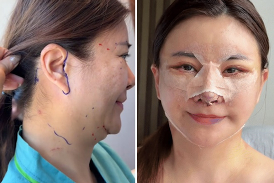 Không nhận ra diễn viên 'đanh đá nhất Việt Nam' hậu sang Hàn trùng tu toàn bộ gương mặt