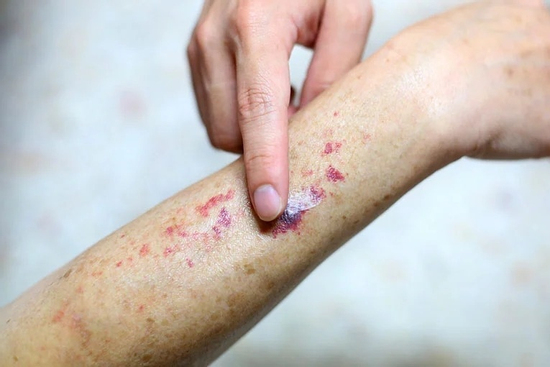 4 thứ này xuất hiện trên da ĐỪNG CHỦ QUAN, e rằng bạn đã mắc ung thư máu!