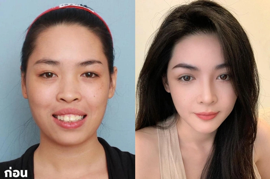 10 năm sau ca phẫu thuật 'thay đầu' thành công nhất Việt Nam: Nữ chính được trao thân phận khác nhưng có 1 điều gây tiếc nuối