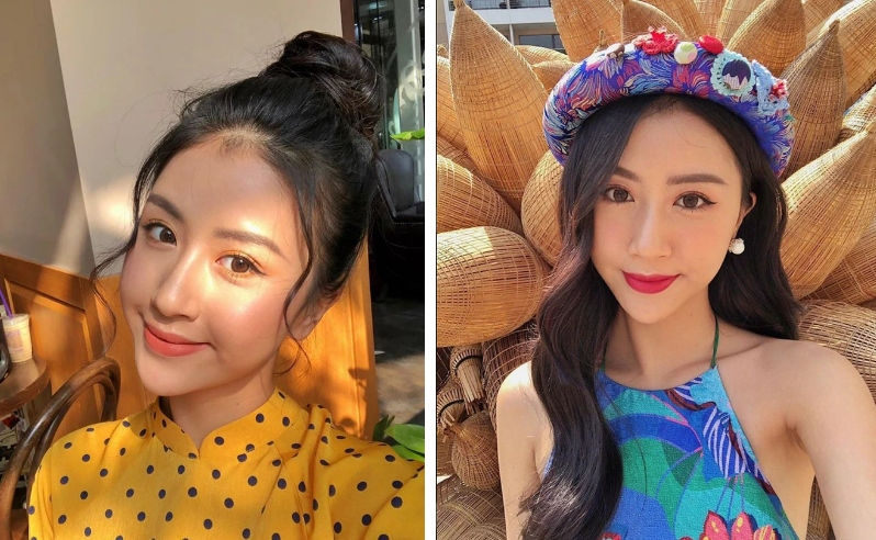 Quỳnh Anh Shyn phẫu thuật thẩm mỹ