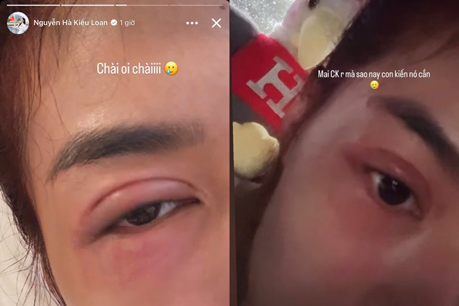 Á hậu Kiều Loan gây hoang mang với gương mặt sưng vù