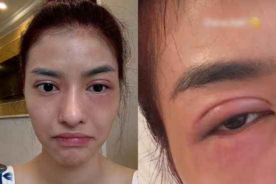 Á hậu Kiều Loan gây hoang mang với gương mặt sưng vù